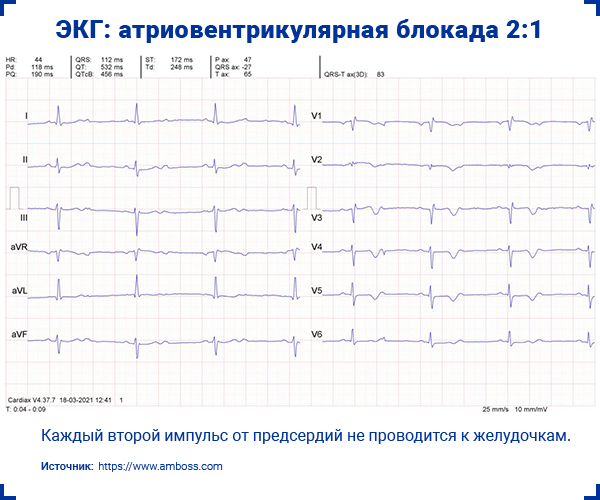 ЭКГ атриовентрикулярная блокада 2-1
